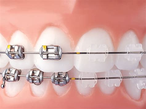 diferencia entre brackets metalicos y de porcelana|Diferencia entre brackets metálicos y de porcelana.